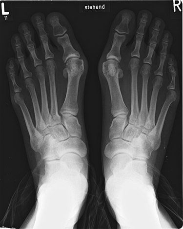 Hallux valgus online steunzolen